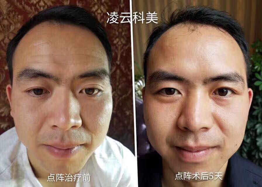 点阵术